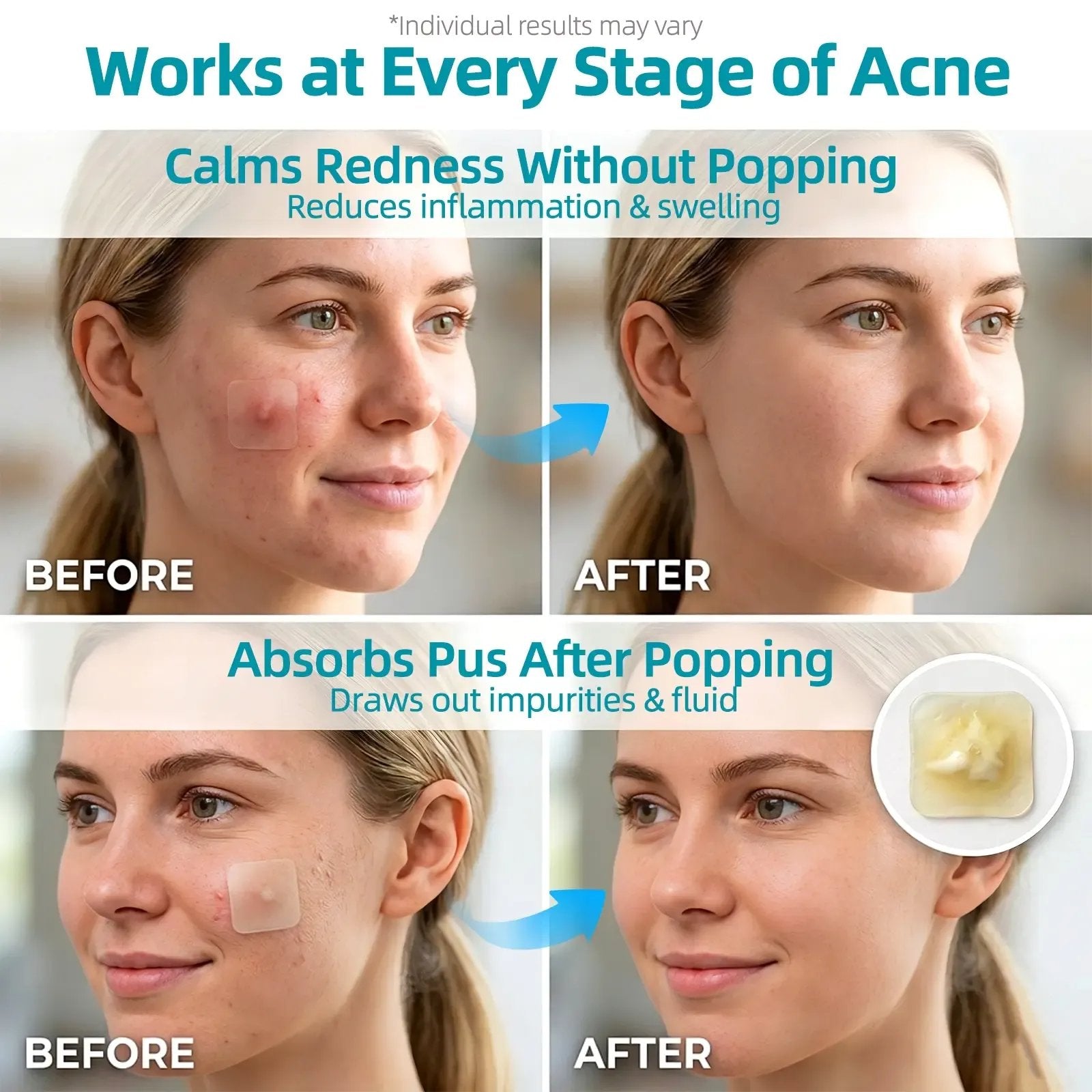 🏆75K+ SOLD!✨ Medical-Grade Hydrocolloid Acne Patch Roll