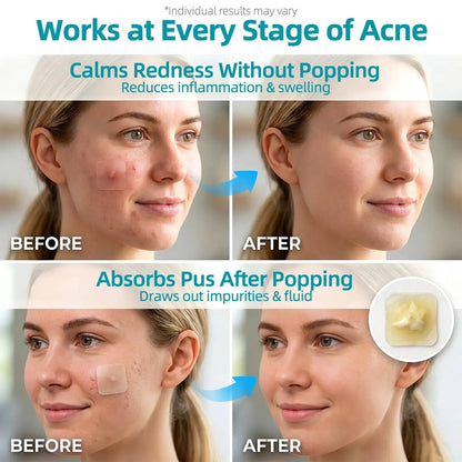 🏆75K+ SOLD!✨ Medical-Grade Hydrocolloid Acne Patch Roll