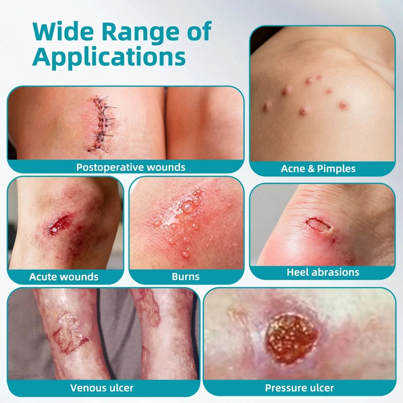 🏆75K+ SOLD!✨ Medical-Grade Hydrocolloid Acne Patch Roll