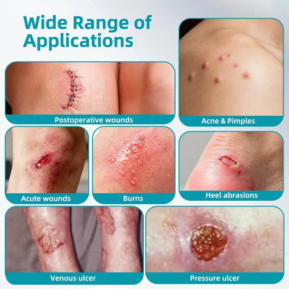 🏆75K+ SOLD!✨ Medical-Grade Hydrocolloid Acne Patch Roll
